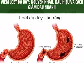 Viêm loét dạ dày: Nguyên nhân, dấu hiệu và cách giảm đau nhanh